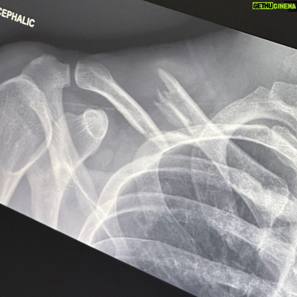 Finneas O'Connell Instagram - Last Friday, I had the pleasure of crashing my electric bike, flying over the handlebars and absolutely demolishing my collarbone as well as sustaining a radial head fracture to my right elbow. The severity of the displacement of my collarbone meant I required surgery which I am now on the other side of and I’m feeling great! I want to give an enormous thank you to Dr. Brian Lee who performed the surgery, Dr. Neal Elattrache and everyone at Kerlan Jobe for their incredible treatment I feel so privileged to have received. I’d also like to thank Jonathan Erb PT for guiding me through the treatment process as well as the ongoing process of physical rehab I now face. I also want to thank my family for their support and love, and most of all Claudia for dropping everything to take care of me the second this happened. She has been an Angel through all of this. I’m told with hard work, I’ll be able to play billie’s forum shows come December which I am so grateful for. As foolish as I felt after the fall, my prevailing emotion is gratitude. You see, I was not wearing a helmet. Lesson forever learned. I feel so lucky to still be here. Take care of yourselves, thank your bodies for all that they do for you. See you all again soon ♥️
