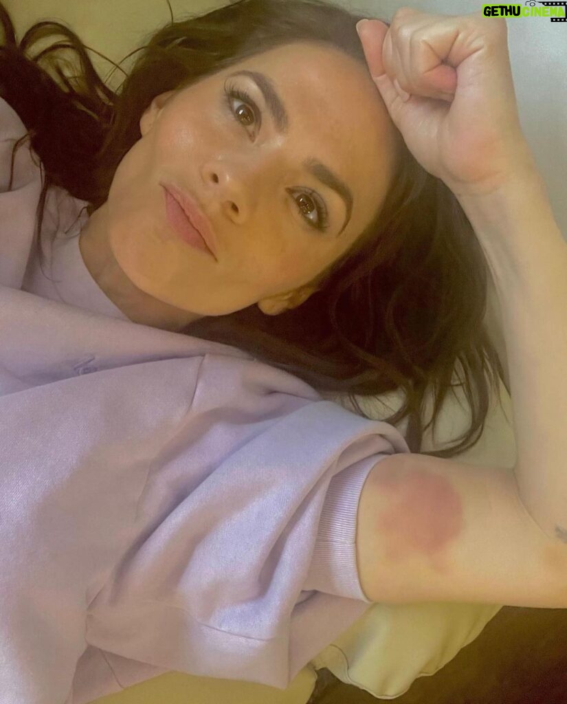 Hayley Atwell Instagram - A little juicy bruising, proudly obtained from doing my own stunts. Arnica cream soon sorted this one out. As a kid, I’d always have bruises on my legs from climbing trees and playing rugby… the price I paid for having outrageous amounts of frantic fun!