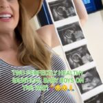 Jamie Otis Instagram - I went from being told if I wanted another baby I’d need IVF to conceiving healthy identical twins naturally🤯 Never, ever believe everything you hear😉🙏 I’ve been diagnosed with a blocked fallopian tube, MTHFR, low-normal AMH, hypothyroidism, secondary infertility, and I’ve been told I’m “Geriatric” for pregnancy👵🏻😅 We were gearing up for IVF, but I just couldn’t believe I needed it since I already have two healthy babies we conceived naturally🤷🏼‍♀️ I decided to change my lifestyle. I began going to the gym. I cut out all alcohol and coffee/energy drinks. I cut waaay back on gluten, dairy, and processed sugars. I began taking any and all supplements that I heard helped others get pregnant and keep their pregnancy! After MONTHS of this and still no luck, I felt kinda defeated. A friend came over and said “give God all the glory” I didn’t even know how to give God all the glory but that night I prayed and said I would. I read a book called supernatural childbirth and it inspired me to try to have total faith in God & stop trying so hard myself.🤷🏼‍♀️ My next ovulation cycle we were on a cruise. I decided to stop peeing on all the ovulation sticks, stop taking my gazillion supplements, stop timing our love life so perfectly —and I prayed the egg would split if I got pregnant.🙏 my hubby wanted to stop at 3 and I’ve always wanted identical twins!😜🥰 A few weeks later I found out I got pregnant naturally … a couple weeks after that I found out there are TWO in me! And a couple weeks after that I found out they are identical 🤯🙏❤️ All of this to say, if you’ve been trying to conceive and it hasn’t been working out for you - I’m so sorry!😞 I know it hurts!😢 The most annoying thing to hear when you’re trying to get pregnant and it hasn’t been working is “just stop trying and you’ll get pregnant”…so I won’t say that! But something happened when I intentionally let go and trusted God❤️ If it worked for me, I believe it can work for you too!🙏 If you’ve read this far I want you to know I am sending you SO MUCH LOVE.💕 Hang in there mama, your rainbow is coming 🌈