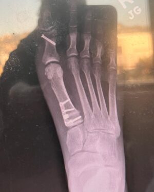 Jodie Sweetin Instagram - Woo hoo! The cast is off and I’m toddling around like a 2 year old.
Literally… baby steps. 

(Scroll through to see my bionic foot)