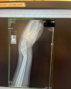 Julie Bowen Instagram - It’s not a vacation without a trip to the ER for a broken wrist… Both bones broken, but John is on the mend and his brothers were total champs.