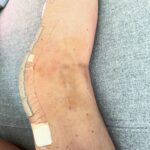 Lindsey Vonn Instagram - After a lot of thought, research and talking to many many doctors, I made the decision to get a knee replacement. I have severe tri-compartment degeneration but the main compartment that has been painful is the lateral compartment, or the outside of my knee. My doctor for many of my surgeries, Dr Hackett, and I did a preparation surgery last July to try to slow down the need for the replacement but also preparing other parts of my knee for the inevitable. But I got to the point where it was too much and my knee could not handle doing the things I love to do. So Dr. Roche did a Mako Robot assisted lateral unicompartmental replacement. In other words, they cut off part of my bone and replaced it with titanium pieces. *in pic 2 Dr Roche and his team did an incredible job and I’m recovering well. I hope this helps me lead the active life I’ve always wanted. Appreciate all of the well wishes🙏🏻 Means a lot to me. But don’t worry, this is just another bump in the road in my journey through life and you know I’ll be back up and running asap 💪🏻 can’t hold me down for long! 🙏🏻❤️