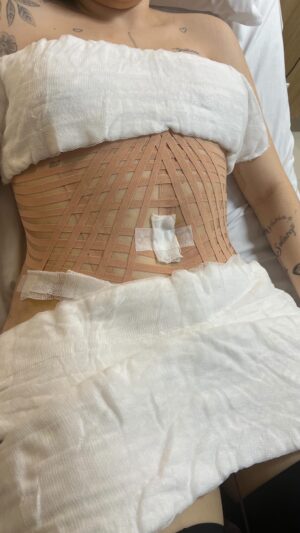 Solange Gomes Instagram - Parte 1 . Etapas. Abdominoplastia com lipo @stephaniegomees Cirurgião plástico @davidsimiss  Em breve, resultado pra vocês. #cirurgiaplastica