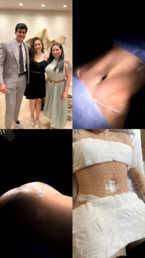 Solange Gomes Instagram - Ainda sem acreditar que essa no vídeo sou eu! Resultado imediato da Lipo   Abdominoplastia e enxertia glútea pela as mãos do Dr. @davidsimiss . Agora, a recuperação me aguarda tendo a minha mãe @gomessolange como a minha enfermeira pessoal ❤️ 

Obs: O resultado final leva algum tempo, mas já deu para ver a minha grande conquista✨