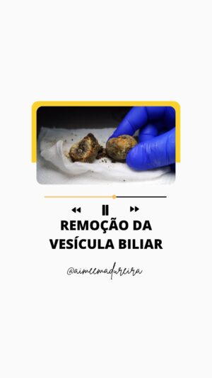 Aimée Madureira Instagram - O excesso de alimentos ultraprocessados, alimentos altamente palatáveis e conhecidos como promovedores do aumento do “colesterol ruim”, provocam o acúmulo de toxinas no organismo e consequentemente interferem no funcionamento dos órgãos.
Nesse vídeo podemos observar o excesso de pedras na vesícula biliar após o procedimento de colecistectomia.
O superdetox auxilia a eliminação das toxinas acumuladas na vesícula e promove a redução e até reversão do quadro.
Melhor que uma cirurgia não é mesmo? 👏
Recupere sua vitalidade e saúde através do #superdetox no @spamariabonitaipanema @spamariabonita ! 🌿🌱💫
#conteúdosensível #superdetox #detox #detoxcorporal #spamariabonita #spa
#repost @biomedicina_descomplicada