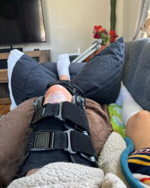 Alexandra Johnson Instagram - One year. ~120 days of physical therapy, 3 MRI’s, 1 ultrasound, 3 surgeon’s opinions, 2 orthopedic sports specialists, 5 amazing PT’s, 3 different braces, 4 new scars, countless unanswered questions, 0 days without pain.
Let’s see what the next 365 bring! 💪