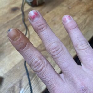 Annie Hamilton Instagram - Let my yellow finger be a lesson to you all