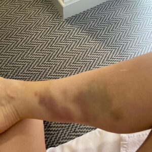 Carley Stenson Instagram - No pain no gain 😊

Im blown away by messages ..I’m slowly getting through them all but just wanna say THANKYOU ..

Im home..not unpacked physically or emotionally ..straight into ct scan and birthday celebrations (still not brushed my hair) 

It is dislocated with a small tear so no movement for me..

As long as I can cuddle and she’s happy I don’t mind 

Will be back soon 😘