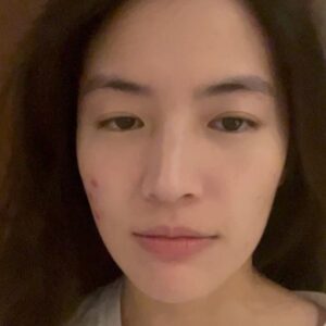 Chollatorn Pratchyaroongroj Instagram - กว่าจะกล้ากลับมาหน้าสดออกนอกบ้าน โปรดชมวีดีโอที่ 3 แล้วจะรู้สาเหตุ 🥹

ช่วงตุลาปีที่แล้ว เป็นช่วงที่ท้อแท้เพราะสิวขึ้นเต็มแก้มเลย และพอหายมันก็ทิ้งรอยแดงไว้เต็มไปหมด 
แต่เมื่อขึ้นมาแล้วก็ต้องทำใจ ต้องรักษา ค่อยๆเคลียร์ไปทีละขั้นตอน ล่าสุดไปเจอทางลัดรักษาสิวที่ @freshcodeclinic 
ฝีมือพี่ๆที่กดสิวให้ที่นี่คือยกให้เป็นอันดับต้นในใจ แบบว่าถูกองศาถูกใจจริงๆ พวกอุดตันที่เตรียมอักเสบหายหมด จากนั้นก็ทำ Dual Yellow ลดรอยแดงไปสองครั้งช่วงพ.ย.และธ.ค. นับจากตุลาที่เป็นช่วงพีคของสิว ผ่านมาประมาณ 3 เดือน จนวันนี้เหลือรอยแค่รูปท้ายๆ พอใจมากเลย ไม่ต้องเมคอัพหนักๆปิดสิวแล้ว วันที่ไม่เจอใครมากก็แค่กันแดดแล้วจบ ชีวิตกลับมาง่ายขึ้นอีกครั้ง นอกจากเมยตูแล้วก็ Dual Yellow นี่แหละที่ช่วยให้เรามั่นใจ ผลพลอยได้คือหน้าเงาผิวละเอียดขึ้นด้วย ✨

จริงๆก็พยายามหาสาเหตุว่าทำไมอยู่ๆสิวระเบิดขนาดนั้นจนคิดว่าน่าจะเพราะเปลี่ยน remover จาก micellar เป็น cleansing milk น่าจะไม่ถูกโฉลกกับเรา ตอนนี้กลับมาใช้ micellar เหมือนเดิมแล้วดีขึ้นแล้วค่ะ ขอเป็นกำลังใจให้คนเป็นสิวทุกคน เดี๋ยวมันก็ผ่านไปนะ พยายามแกะรูทีนตัวเองให้ได้ว่าใช้อะไรผิดไป และหาทางรักษาอย่างถูกวิธี ปรึกษาคุณหมอด้วยจะได้หายไวไวค่ะ 🫶🏻