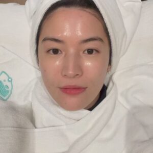 Chollatorn Pratchyaroongroj Instagram - กว่าจะกล้ากลับมาหน้าสดออกนอกบ้าน โปรดชมวีดีโอที่ 3 แล้วจะรู้สาเหตุ 🥹

ช่วงตุลาปีที่แล้ว เป็นช่วงที่ท้อแท้เพราะสิวขึ้นเต็มแก้มเลย และพอหายมันก็ทิ้งรอยแดงไว้เต็มไปหมด 
แต่เมื่อขึ้นมาแล้วก็ต้องทำใจ ต้องรักษา ค่อยๆเคลียร์ไปทีละขั้นตอน ล่าสุดไปเจอทางลัดรักษาสิวที่ @freshcodeclinic 
ฝีมือพี่ๆที่กดสิวให้ที่นี่คือยกให้เป็นอันดับต้นในใจ แบบว่าถูกองศาถูกใจจริงๆ พวกอุดตันที่เตรียมอักเสบหายหมด จากนั้นก็ทำ Dual Yellow ลดรอยแดงไปสองครั้งช่วงพ.ย.และธ.ค. นับจากตุลาที่เป็นช่วงพีคของสิว ผ่านมาประมาณ 3 เดือน จนวันนี้เหลือรอยแค่รูปท้ายๆ พอใจมากเลย ไม่ต้องเมคอัพหนักๆปิดสิวแล้ว วันที่ไม่เจอใครมากก็แค่กันแดดแล้วจบ ชีวิตกลับมาง่ายขึ้นอีกครั้ง นอกจากเมยตูแล้วก็ Dual Yellow นี่แหละที่ช่วยให้เรามั่นใจ ผลพลอยได้คือหน้าเงาผิวละเอียดขึ้นด้วย ✨

จริงๆก็พยายามหาสาเหตุว่าทำไมอยู่ๆสิวระเบิดขนาดนั้นจนคิดว่าน่าจะเพราะเปลี่ยน remover จาก micellar เป็น cleansing milk น่าจะไม่ถูกโฉลกกับเรา ตอนนี้กลับมาใช้ micellar เหมือนเดิมแล้วดีขึ้นแล้วค่ะ ขอเป็นกำลังใจให้คนเป็นสิวทุกคน เดี๋ยวมันก็ผ่านไปนะ พยายามแกะรูทีนตัวเองให้ได้ว่าใช้อะไรผิดไป และหาทางรักษาอย่างถูกวิธี ปรึกษาคุณหมอด้วยจะได้หายไวไวค่ะ 🫶🏻