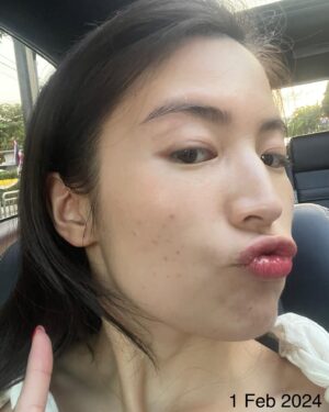 Chollatorn Pratchyaroongroj Instagram - กว่าจะกล้ากลับมาหน้าสดออกนอกบ้าน โปรดชมวีดีโอที่ 3 แล้วจะรู้สาเหตุ 🥹

ช่วงตุลาปีที่แล้ว เป็นช่วงที่ท้อแท้เพราะสิวขึ้นเต็มแก้มเลย และพอหายมันก็ทิ้งรอยแดงไว้เต็มไปหมด 
แต่เมื่อขึ้นมาแล้วก็ต้องทำใจ ต้องรักษา ค่อยๆเคลียร์ไปทีละขั้นตอน ล่าสุดไปเจอทางลัดรักษาสิวที่ @freshcodeclinic 
ฝีมือพี่ๆที่กดสิวให้ที่นี่คือยกให้เป็นอันดับต้นในใจ แบบว่าถูกองศาถูกใจจริงๆ พวกอุดตันที่เตรียมอักเสบหายหมด จากนั้นก็ทำ Dual Yellow ลดรอยแดงไปสองครั้งช่วงพ.ย.และธ.ค. นับจากตุลาที่เป็นช่วงพีคของสิว ผ่านมาประมาณ 3 เดือน จนวันนี้เหลือรอยแค่รูปท้ายๆ พอใจมากเลย ไม่ต้องเมคอัพหนักๆปิดสิวแล้ว วันที่ไม่เจอใครมากก็แค่กันแดดแล้วจบ ชีวิตกลับมาง่ายขึ้นอีกครั้ง นอกจากเมยตูแล้วก็ Dual Yellow นี่แหละที่ช่วยให้เรามั่นใจ ผลพลอยได้คือหน้าเงาผิวละเอียดขึ้นด้วย ✨

จริงๆก็พยายามหาสาเหตุว่าทำไมอยู่ๆสิวระเบิดขนาดนั้นจนคิดว่าน่าจะเพราะเปลี่ยน remover จาก micellar เป็น cleansing milk น่าจะไม่ถูกโฉลกกับเรา ตอนนี้กลับมาใช้ micellar เหมือนเดิมแล้วดีขึ้นแล้วค่ะ ขอเป็นกำลังใจให้คนเป็นสิวทุกคน เดี๋ยวมันก็ผ่านไปนะ พยายามแกะรูทีนตัวเองให้ได้ว่าใช้อะไรผิดไป และหาทางรักษาอย่างถูกวิธี ปรึกษาคุณหมอด้วยจะได้หายไวไวค่ะ 🫶🏻