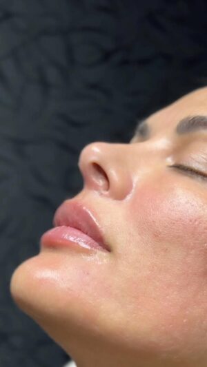 Christina Dieckmann Instagram - La importancia de la evaluación médica es fundamental para dar un diagnóstico y establecer un plan de tratamientos adecuados; de acuerdo a los requerimientos individuales de cada persona, y es que para lograr una #armonizacionfacial hay que combinar técnicas y procedimientos médicos con el fin de obtener resultado óptimos y duraderos, siempre manteniendo y respetando lo estético y natural. 
. 
Gracias @chrisdieckmann por confiar el cuidado de tu rostro en mis manos.

#lips #labios #esteticafacial