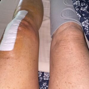 Dot-Marie Jones Instagram - I haven’t post anything about my knee replacement. I know my girl @bridgettcjones had but wanted to as well. My knee was a mess and this was the 8th surgery on my left one. I think I got my miles out of it. 9-12-23 was surgery! Have had some very bad days but slowly getting better! Thank you @bridgettcjones for being an amazing nurse and taking good care of me . I love you forever and always.  I made that fancy cup and stuff holder for my Walker!!! Jealous 😉love y’all! I’ll keep y’all up to date! Today is day 8. Ya don’t count the day ya had the surgery cause ya don’t!!!