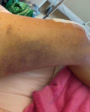 Dot-Marie Jones Instagram - I haven’t post anything about my knee replacement. I know my girl @bridgettcjones had but wanted to as well. My knee was a mess and this was the 8th surgery on my left one. I think I got my miles out of it. 9-12-23 was surgery! Have had some very bad days but slowly getting better! Thank you @bridgettcjones for being an amazing nurse and taking good care of me . I love you forever and always.  I made that fancy cup and stuff holder for my Walker!!! Jealous 😉love y’all! I’ll keep y’all up to date! Today is day 8. Ya don’t count the day ya had the surgery cause ya don’t!!!