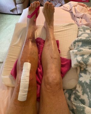 Dot-Marie Jones Instagram - I haven’t post anything about my knee replacement. I know my girl @bridgettcjones had but wanted to as well. My knee was a mess and this was the 8th surgery on my left one. I think I got my miles out of it. 9-12-23 was surgery! Have had some very bad days but slowly getting better! Thank you @bridgettcjones for being an amazing nurse and taking good care of me . I love you forever and always.  I made that fancy cup and stuff holder for my Walker!!! Jealous 😉love y’all! I’ll keep y’all up to date! Today is day 8. Ya don’t count the day ya had the surgery cause ya don’t!!!
