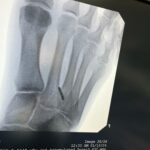 Felicity Palmateer Instagram - New year. New foot 🫠 Didn’t think I needed anymore character development just yet… but here we are… I know what it feels like to fold my entire foot backwards - don’t recommend it. Getting injured sucks. But being injured, away from your loved ones and getting surgery in a different country to home is pretty daunting. Extremely grateful to my sis @courtneyconlogue who’s taken me on as her patient and made me feel like family. @fredericksdaughter - just thank you 🖤 I couldn’t have done this without you women. To the people that have been on the other end of the phone and provided me with lots of free therapy - I love you all so much. MVP’s go to @drwarreng & Dr Harris who made this last week as pain free and as smooth as can be. I can’t express how grateful I am 🙏🏽 After last year’s season, I was geared up for something bigger, feeling the most mentally, physically, and emotionally prepared I’d ever been for a big wave season. I’m not sure when I’ll be back yet but it’s heartbreaking to not have the chance to make the most of it. Send Netflix reccos please 😂