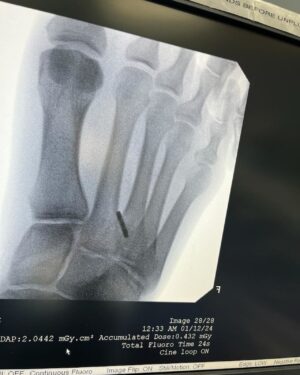 Felicity Palmateer Instagram - New year. New foot 🫠

Didn’t think I needed anymore character development just yet… but here we are… I know what it feels like to fold my entire foot backwards - don’t recommend it. 

Getting injured sucks. But being injured, away from your loved ones and getting surgery in a different country to home is pretty daunting. Extremely grateful to my sis @courtneyconlogue who’s taken me on as her patient and made me feel like family. @fredericksdaughter - just thank you 🖤 I couldn’t have done this without you women. To the people that have been on the other end of the phone and provided me with lots of free therapy - I love you all so much. 

MVP’s go to @drwarreng & Dr Harris who made this last week as pain free and as smooth as can be. I can’t express how grateful I am 🙏🏽

After last year’s season, I was geared up for something bigger, feeling the most mentally, physically, and emotionally prepared I’d ever been for a big wave season. I’m not sure when I’ll be back yet but it’s heartbreaking to not have the chance to make the most of it. 

Send Netflix reccos please 😂