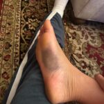 Felicity Palmateer Instagram - New year. New foot 🫠 Didn’t think I needed anymore character development just yet… but here we are… I know what it feels like to fold my entire foot backwards - don’t recommend it. Getting injured sucks. But being injured, away from your loved ones and getting surgery in a different country to home is pretty daunting. Extremely grateful to my sis @courtneyconlogue who’s taken me on as her patient and made me feel like family. @fredericksdaughter - just thank you 🖤 I couldn’t have done this without you women. To the people that have been on the other end of the phone and provided me with lots of free therapy - I love you all so much. MVP’s go to @drwarreng & Dr Harris who made this last week as pain free and as smooth as can be. I can’t express how grateful I am 🙏🏽 After last year’s season, I was geared up for something bigger, feeling the most mentally, physically, and emotionally prepared I’d ever been for a big wave season. I’m not sure when I’ll be back yet but it’s heartbreaking to not have the chance to make the most of it. Send Netflix reccos please 😂