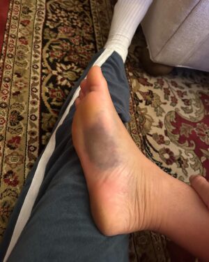 Felicity Palmateer Instagram - New year. New foot 🫠

Didn’t think I needed anymore character development just yet… but here we are… I know what it feels like to fold my entire foot backwards - don’t recommend it. 

Getting injured sucks. But being injured, away from your loved ones and getting surgery in a different country to home is pretty daunting. Extremely grateful to my sis @courtneyconlogue who’s taken me on as her patient and made me feel like family. @fredericksdaughter - just thank you 🖤 I couldn’t have done this without you women. To the people that have been on the other end of the phone and provided me with lots of free therapy - I love you all so much. 

MVP’s go to @drwarreng & Dr Harris who made this last week as pain free and as smooth as can be. I can’t express how grateful I am 🙏🏽

After last year’s season, I was geared up for something bigger, feeling the most mentally, physically, and emotionally prepared I’d ever been for a big wave season. I’m not sure when I’ll be back yet but it’s heartbreaking to not have the chance to make the most of it. 

Send Netflix reccos please 😂