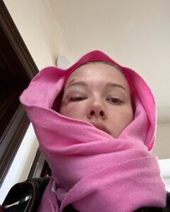 Jessica Alexander Instagram - gna keep it real Vienna was great but I also face planted off a lime scooter and got stitches 🫶🏼 so in the interest of transparency plz enjoy these pics of me serving with a face wound. & in the words of Alfred Pennyworth, why do we fall Bruce? So we can learn to pick ourselves up 🤝🏼🫡