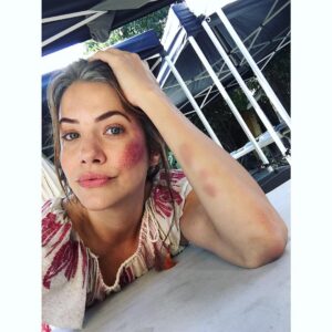 Julie Gonzalo Instagram - Art hurts. #facebruisefake #armbruisesarereal #thegreatillusion