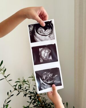 Julie St-Pierre Instagram - Et oui!!! 17 semaines aujourd’hui. Privilégiés de pouvoir réaliser ce souhait que nous avons toujours eu d’avoir trois enfants. 🫶🏼

Merci à la @cliniqueovo.prenatal (et non fertilité 😉) que je choisis depuis ma toute première grossesse pour leur accompagnement et leurs services. J’y fais mes suivis, toutes mes échographies, dont la première pour la clarté nucale, et on m’a aussi offert cette fois le dépistage prénatal d’ADN fœtal Harmony qui est maintenant réalisé à même leur laboratoire à Montréal ! Il est aussi recommandé pour les femmes âgées de 35 ans et plus. Le dépistage Harmony est réalisé à partir d’une simple prise de sang qui permet de dépister les trisomies 13, 18 et 21, les anomalies des chromosomes sexuels et le sexe fœtal, à partir de 10 semaines de grossesse. 

Nous connaissons donc déjà le sexe du bébé, mais je garde la surprise encore un peu! 😉 Selon vous, fille ou garçon? 🩷🩵

#pregnancyannouncement #17weekspregnant #babynumber3 #familyof5