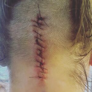 Kirsten Storms Instagram - “Yes, duh” had 100% of the vote this morning to see the back of my head. I didn’t know you guys would be up for it! Swipe to see the pic from last week! After I wash my hair today 🙌🏼🙌🏼🙌🏼 I will get my friend @iamdorellanthony (can’t wait to see yoooou ♥️) to take another pic w/o the stitches - since it’s looking a little better now.