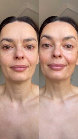 Melânia Gomes Instagram - Antes e depois...
Conseguem perceber as diferenças, certo?

A minha pele também, depois de ter começado a usar os produtos personalizados de skincare da @mahg.pro , já não quer outra coisa.
Até modelar o rosto e corrigir imperfeições eu consigo fazer, sem maquilhagem. Tudo só com os produtos de skincare!

Cada pessoa é única, cada pele também e a @mahg.pro faz cada produto especificamente para ti, conforme as características da tua pele, aproveita! 
Marca uma consulta on-line, para a partir daí ser possível desenvolver os teus produtos, conforme os teus objetivos, as características e necessidades da tua pele.
Isto é único! ✨🤍

#skincare #parceria #rotinadedia #personalizada #simples #minimalista #vegan #crueltyfree