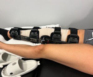 Peyton Evans Instagram - I’m in a hinge brace now. Starting PT this week. I’m scared. I’m in so much pain and I don’t want to have to ever have this surgery again. 

10 days post op. 
#aclremovalrecovery #kneerecoveryjourney #kneerecovery #peytonkaye