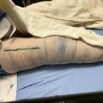 Peyton Evans Instagram - Well here is an update on my lovely knee journey. In attempts to tryout for cheer for next season I injured my knee again. I had surgery AGAIN! Friday the docs went in and completely removed my ACL, removed a cyclops lesion under my kneecap, repaired my MCL, released my PCL and shaved my kneecap to allow range of motion. I’ve been put in a full cast for 3 weeks to keep my leg in a straight position. The recovery time is 6-9 months with intense physical therapy. Definitely not what I expected! I have a long road ahead of me. #peytonkaye #kneeinjury #kneesurgery #thisdefinitelysucks