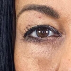 Rita Guerra Instagram - Quando considerei fazer uma blefaroplastia, procurei exactamente o que se pode confirmar nas fotos: retirar o excesso de pele, sem exageros, de modo a abrir novamente o olhar mantendo a minha expressão natural. 
Para isso dirigi-me à  @clinicaonyx onde pude contar com a ajuda do @drdiogoribeiro.pt.
Após ver o resultado, o meu sogro decidiu fazer a mesma intervenção,  uma vez que tinha as pálpebras muito descaídas sobre a vista.
Brevemente partilharei também as fotos dos olhos dele para que possam ver a diferença enorme . 
Este é um problema que os homens têm mais que as mulheres e que chega a afectar a visão. 
Cada vez mais os homens deixam os preconceitos para trás e procuram ajuda também a este nível. 
Muito obrigada a todos na Clínica, bem como a toda equipa médica que assistiu à minha intervenção 🥰🤗
