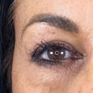Rita Guerra Instagram - Quando considerei fazer uma blefaroplastia, procurei exactamente o que se pode confirmar nas fotos: retirar o excesso de pele, sem exageros, de modo a abrir novamente o olhar mantendo a minha expressão natural. 
Para isso dirigi-me à  @clinicaonyx onde pude contar com a ajuda do @drdiogoribeiro.pt.
Após ver o resultado, o meu sogro decidiu fazer a mesma intervenção,  uma vez que tinha as pálpebras muito descaídas sobre a vista.
Brevemente partilharei também as fotos dos olhos dele para que possam ver a diferença enorme . 
Este é um problema que os homens têm mais que as mulheres e que chega a afectar a visão. 
Cada vez mais os homens deixam os preconceitos para trás e procuram ajuda também a este nível. 
Muito obrigada a todos na Clínica, bem como a toda equipa médica que assistiu à minha intervenção 🥰🤗