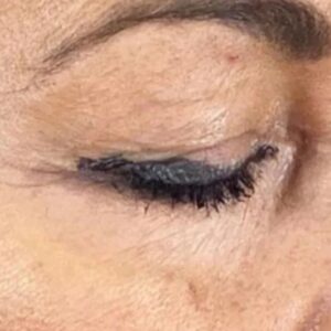 Rita Guerra Instagram - Quando considerei fazer uma blefaroplastia, procurei exactamente o que se pode confirmar nas fotos: retirar o excesso de pele, sem exageros, de modo a abrir novamente o olhar mantendo a minha expressão natural. 
Para isso dirigi-me à  @clinicaonyx onde pude contar com a ajuda do @drdiogoribeiro.pt.
Após ver o resultado, o meu sogro decidiu fazer a mesma intervenção,  uma vez que tinha as pálpebras muito descaídas sobre a vista.
Brevemente partilharei também as fotos dos olhos dele para que possam ver a diferença enorme . 
Este é um problema que os homens têm mais que as mulheres e que chega a afectar a visão. 
Cada vez mais os homens deixam os preconceitos para trás e procuram ajuda também a este nível. 
Muito obrigada a todos na Clínica, bem como a toda equipa médica que assistiu à minha intervenção 🥰🤗