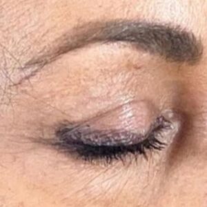 Rita Guerra Instagram - Quando considerei fazer uma blefaroplastia, procurei exactamente o que se pode confirmar nas fotos: retirar o excesso de pele, sem exageros, de modo a abrir novamente o olhar mantendo a minha expressão natural. 
Para isso dirigi-me à  @clinicaonyx onde pude contar com a ajuda do @drdiogoribeiro.pt.
Após ver o resultado, o meu sogro decidiu fazer a mesma intervenção,  uma vez que tinha as pálpebras muito descaídas sobre a vista.
Brevemente partilharei também as fotos dos olhos dele para que possam ver a diferença enorme . 
Este é um problema que os homens têm mais que as mulheres e que chega a afectar a visão. 
Cada vez mais os homens deixam os preconceitos para trás e procuram ajuda também a este nível. 
Muito obrigada a todos na Clínica, bem como a toda equipa médica que assistiu à minha intervenção 🥰🤗