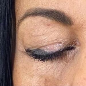 Rita Guerra Instagram - Quando considerei fazer uma blefaroplastia, procurei exactamente o que se pode confirmar nas fotos: retirar o excesso de pele, sem exageros, de modo a abrir novamente o olhar mantendo a minha expressão natural. 
Para isso dirigi-me à  @clinicaonyx onde pude contar com a ajuda do @drdiogoribeiro.pt.
Após ver o resultado, o meu sogro decidiu fazer a mesma intervenção,  uma vez que tinha as pálpebras muito descaídas sobre a vista.
Brevemente partilharei também as fotos dos olhos dele para que possam ver a diferença enorme . 
Este é um problema que os homens têm mais que as mulheres e que chega a afectar a visão. 
Cada vez mais os homens deixam os preconceitos para trás e procuram ajuda também a este nível. 
Muito obrigada a todos na Clínica, bem como a toda equipa médica que assistiu à minha intervenção 🥰🤗