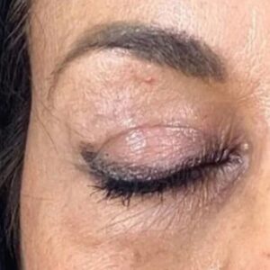 Rita Guerra Instagram - Quando considerei fazer uma blefaroplastia, procurei exactamente o que se pode confirmar nas fotos: retirar o excesso de pele, sem exageros, de modo a abrir novamente o olhar mantendo a minha expressão natural. 
Para isso dirigi-me à  @clinicaonyx onde pude contar com a ajuda do @drdiogoribeiro.pt.
Após ver o resultado, o meu sogro decidiu fazer a mesma intervenção,  uma vez que tinha as pálpebras muito descaídas sobre a vista.
Brevemente partilharei também as fotos dos olhos dele para que possam ver a diferença enorme . 
Este é um problema que os homens têm mais que as mulheres e que chega a afectar a visão. 
Cada vez mais os homens deixam os preconceitos para trás e procuram ajuda também a este nível. 
Muito obrigada a todos na Clínica, bem como a toda equipa médica que assistiu à minha intervenção 🥰🤗