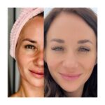 Sandra Nováková Instagram - Před a po. O tuhle “proměnu” se s vámi prostě musím podělit, protože jsem z výsledku naprosto nadšená. Myslím, že většina žen se na internetech kosmetickými zákroky příliš nechlubí, stále totiž ve společnosti převládá názor, že přirozenost nade vše a ženy by se měly smířit samy se sebou. Já si to nemyslím, naopak jsem vděčná za tuhle dobu, která nám nabízí neskutečně mnoho možností, jak si zvednout sebevědomí a jak se líbit sama sobě víc. Samozřejmě má každý tu míru jinde, někdo se potřebuje všude přifouknout, někdo si naopak vyhledává zákroky, které vylepší, ale budou vypadat co nejpřirozeněji. A to jsem já. Starám se o sebe už od prvních vrásek, které jsem na sobě spatřila. A vystřídala jsem spoustu klinik, než jsem našla tu nejlepší. Tu, která vyznává především přirozenou krásu. Kliniku Formositas. Tady vám totiž nepovolí zákrok, který nepotřebujete nebo pro vás není vhodný. Tady vás chtějí poznat, zjistí co vás trápí a navrhnou vám řešení, které bude vypadat co nejpřirozeněji. A ještě s ohledem na váš rozpočet. A na fotce můžete vidět, jaké má jejich péče výsledky. Trápily mě kruhy pod očima. Ale bála jsem se klasických výplní, protože nechci vypadat jako vosková figurína. A tak mě seznámili s biostimulanty Lenisnou a Juvelookem. Jedná se o produkty, které jako jediné na trhu obsahují kyselinu poly-D, L-mléčnou a volnou kyselinu hyaluronovou (a ne karboxymethylcelulózu). Biostimulanty startují reprodukci vlastního kolagenu a zároveň do jisté míry nahrazují tradiční výplně díky své schopnosti restaurovat objem či tvořit oporu pro měkké tkáně. Zjednodušeně řečeno, prostě vaše tělo donutí vytvořit si vlastní kolagen. A to zcela bez rizika. No a na fotce můžete vidět rozdíl po jediné aplikaci. Kruhy jsou pryč a výsledek je zcela přirozený. Takže opět DĚKUJU @klinika_formositas a @shapeyourbody.cz za to, že Vás mám a že se o mě tak krásně staráte❤️ #loveyou #takecareofyourself