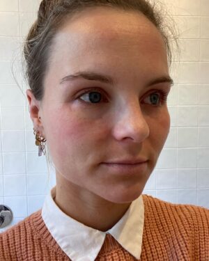 Stijn Fransen Instagram - Mijn hoofd 😁 Die heeft al de hele week een dikke vette error. Mega dikke allergie ogen en opgezwollen wangen en eczeem op mijn voorhoofd. Ik zie er uit alsof ik mega heb gehuild terwijl ik mij kei goed voel hahaha 😉 Niets wat helaas de zwelling tegen kan gaan maar de jeuk wel. Echt ik leef met het Toleriane serum en de oogcreme op zak deze dagen. Want zodra ik jeuk krijg kan ik er meteen wat opsmeren! Het serum is verzachtend en hydraterend en verrijkt met Neurosensine. Het helpt direct intensief te verminderen en om de huidbarrière te helpen herstellen ❤️‍🩹 
Kortom daarom zit hij in mijn zak deze week 🙌 

#toleriane #trotseambassadeur #ambassador #LRPLOVE #partner @larocheposay