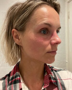 Stijn Fransen Instagram - Redder in nood 🆘 Voor iedereen die de Cicaplast Baume B5 niet kent. Dit is echt je redder in nood in alle omstandigheden. Zoals je op de foto ziet had ik gisteravond opeens een mega eczeem uitbraak. Dus dan doen ik er een laagje op voordat ik ga slapen. Maar ook op Lieuwe zijn billen is het super fijn. Met dit weer als de kloven in mijn vingers springen. Oprecht in elke tas samen met mijn Cicaplast lippenbalsem zit een tube Cicaplast Baume B5. 
En nou is die vernieuwd er staat een   achter de 5. Het Herstelt optimaal de huidbarrière: Madecassoside   Koper - Zink - Mangaan   Tribioma. 
Verzacht droge, geïrriteerd aanvoelende zones: 5% Panthenol. En beschermt de huid: Rijke en voedende textuur. 

#proudambasaseur #trotseambassadeur #ambassador #LRP #cicaplast #baumeb5  #publiciteit @larocheposay