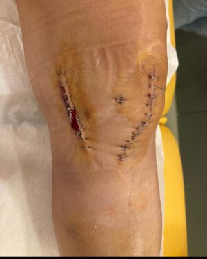 Telma Monteiro Instagram - Não vejam (!!) a 4ª foto se são sensíveis a cicatrizes e sangue. Foi tirada há menos de 6 meses, quando fui tirar alguns agrafos. Nesse momento tinha cerca de 5 meses pra voltar a competir e lutar pela qualificação olímpica #paris2024, depois da operação ao LCA, Ligamento Lateral Interno, Menisco. 

Voltámos! Contra todas as expectativas e prognósticos. Até agora, 18 dias, 3 competições. Falta uma, Campeonato do Mundo, será a 4ª em um mês.
Depois de tudo o que passei, já nada me assusta!!

Tem sido extremamente exigente, física e mentalmente mas também a experiência mais incrível da minha vida.
Eu escolhi estar aqui, nesta luta! E é com a garra e acreditar de sempre  que seguimos! A única coisa que sinto é gratidão por tudo o que já foi superado e vivido e vontade de fazer ainda mais!

Agora é “Noise canceling” em tudo o que não importa, em tudo o que não acrescenta. Foco no que podemos controlar, junto dos que querem e acreditam e vamos com tudo!

Obrigada pela boa energia nos últimos meses, semanas, dias ❤️‍🔥