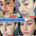 Vichuda Pindum Instagram – 💥Promotion ราคาพิเศษ หมดแล้วหมดเลย💥
.
Kelosil 3 หลอด จากปกติราคา 2,900.-
💙พิเศษ 3 หลอด 999.-💙 พร้อมจัดส่งฟรี
👉🔴 ทักไลน์ wichudapindum 🔴

🔥🔥Promotion พิเศษฉลอง 20 ปี🔥🔥 Kelosil ลดรอยแผลเป็น‼ 
เจลลดรอยแผลเป็นแบบ “ เคลือบ “ 
!!!! ท้าให้ลอง👍🏻💗
.
สามารถทาที่ไหนได้บ้าง ❓
✅ แผลคีลอยด์
✅ แผลเป็น
✅ แผลพุพอง(ที่หายสนิทแล้ว)
✅ แผลผ่าตัด
✅ แผลที่เกิดจากสิว
✅ แผลนูนแดง
✅ แผลจากอุบัติเหตุ