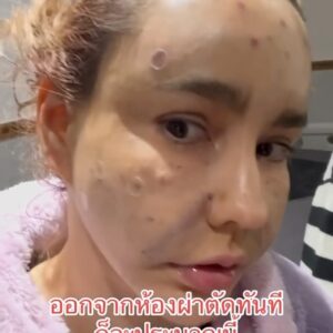 Vichuda Pindum Instagram - #day2 #korea #ศัลยกรรม @daplasticsurgery_th