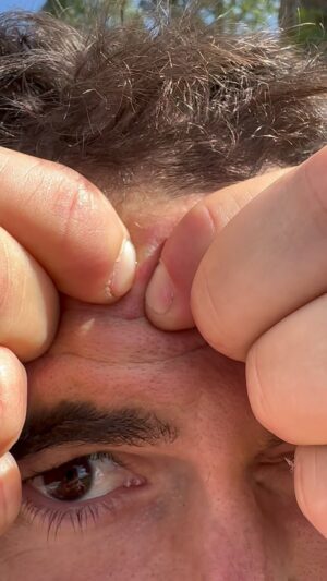 Ahikar Azcona Instagram - Espinilla🤕