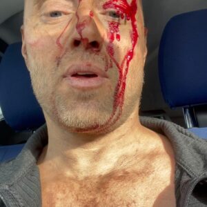 Aksel Hennie Instagram - ACCIDENT ON SET! ….just another example on the obvious fact that life is filled with risk. We can try to blame ourselves or others, make rules or whatever else to try to regulate consequences of our actions, but accidents will continue to happen as long as human beings are involved… #life #sisu #shootingmovies #actorlife
