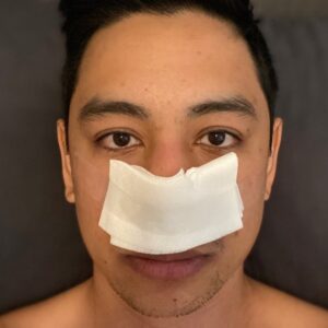 Alfredo Diaz Instagram - Lots of pain and bleeding, but it’ll all be worth it once I can breathe out of my nose. There’s about to be so much o2 flowing into this brain now that I don’t have a deviated septum.