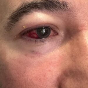 Alper Çağlar Instagram - @selcukgulderen, İLK GÖKTÜRK'te bir Aşina Şadını oynayan aslan parçası biricik cengaver; retinasında oluşan iki yırtık yüzünden o gözü kaybetmemek için olan müdahaleden aslanlar gibi çıktı. Bu film için ne kemikler kırıldı, neler göze alındı, hala dayanıyoruz. Bu dağı deleceğiz. Geçmiş olsun can dostum. NOT: Filmle alakası olmayan genetik bir mevzu, ama gene de ailemdir Selçuk, bu durum çok önemli benim için.
//////
Selçuk Gülderen, the one and only brobeans lion who plays an Ashina Prince in THE FIRST GÖKTÜRK; has completed a critical intervention to avoid losing one of his eyes due to two tears in his retina. The tribulations of this film could be a film in its own right. But no matter how many bones were broken, or risks that were taken, we are still holding on for dear life. We will prevail. Get well soon my dear friend.