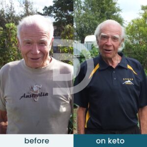 Andreas Eenfeldt Instagram - A heart attack followed by a triple bypass made Arthur realize how unhealthy his diet was. At 76 years old, he took this as a second chance and switched to a low carb diet. ⁠
⁠
That was 12 years ago, and as Arthur approaches 90, he's still going strong. He says he gets goosebumps thinking about how unhealthy his diet was before discovering Diet Doctor.⁠
⁠
Well done, Arthur! You're such an inspiration! ⭐️ ⁠
⁠
Arthur's full story is linked in our bio @diet_doctor⁠
.⁠
.⁠
.⁠
.⁠
.⁠
.⁠
.⁠
⁠
#health #wellness #selfcare #motivation #healthy #healthylifestyle #selflove #nutrition #lifestyle #inspiration #healthyliving #wellbeing #healthyfood  #dietdoctor #lowcarb  #lchf #glutenfree #fitfood #weightloss #eatclean