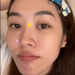 Arikanta Mahapreukpong Instagram - Pimple season