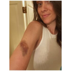 Ashlynn Yennie Instagram - She bruises like a peach 🍑  Bruise is 💯 REAL. I may or may not have run into a car door while frantically searching for my fake son 😖 In my defense there was a gigantic hedge and light I had to avoid, and I successfully avoided both. Go Me. #methodactor #walkitoff #bruiselikeapeach