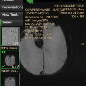 Barton Cowperthwaite Instagram - Just got home from My craniotomy, @nyulangone doctors are saying that it was an incredibly successful operation. New phase of the process is starting now! 1)diagnosis 2)surgery 3)recovery LFG FAM, We will know more when the molecular pathology comes back in a couple weeks! #easyasonetwothree #bestthanksgivingever #grateful #totalresection #holeinone thank you from the bottom of my heart for the love and support. I really do love you all right back 🫰🏼